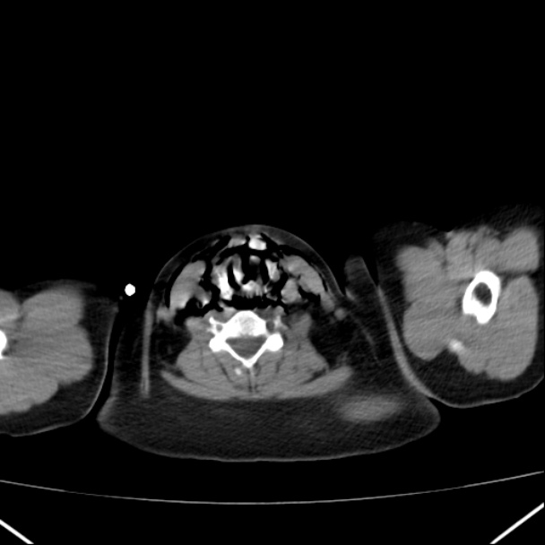 Boerhaave syndrome (Radiopaedia 45644-49799 Axial non-contrast 8).jpg