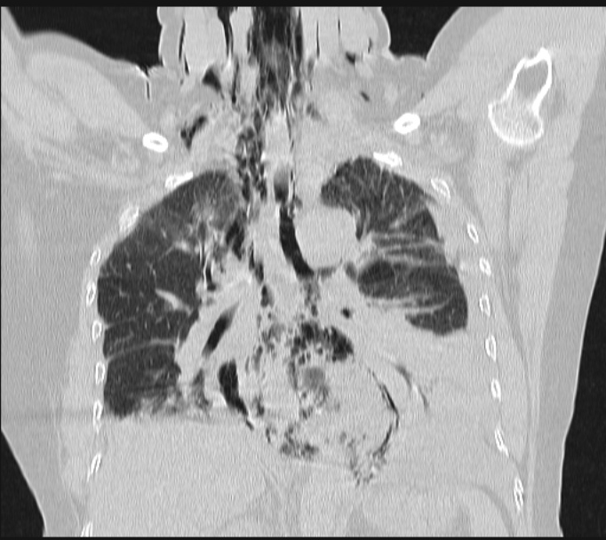 Boerhaave syndrome (Radiopaedia 45644-49799 Coronal lung window 40).jpg