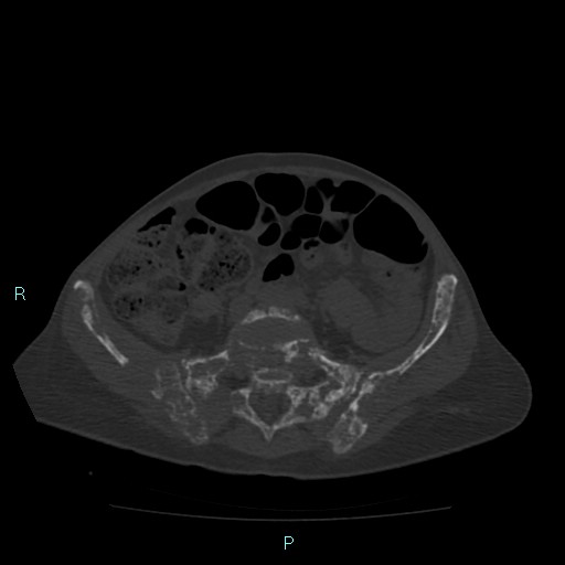File:Bone metastases from untreated breast cancer (Radiopaedia 42973-46219 Axial bone window 146).jpg
