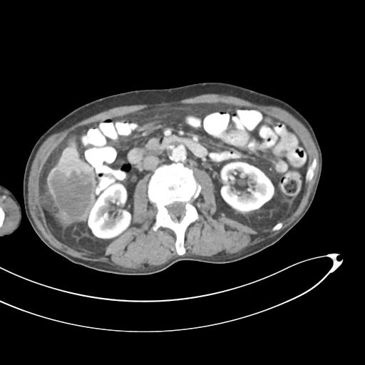 Bone metastasis from squamous cell carcinoma (Radiopaedia 30133-30730 B 33).jpg