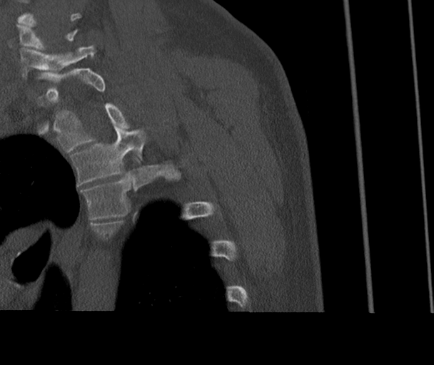 Bony Bankart and Hill-Sachs lesions (Radiopaedia 33622-34727 Sagittal bone window 79).png