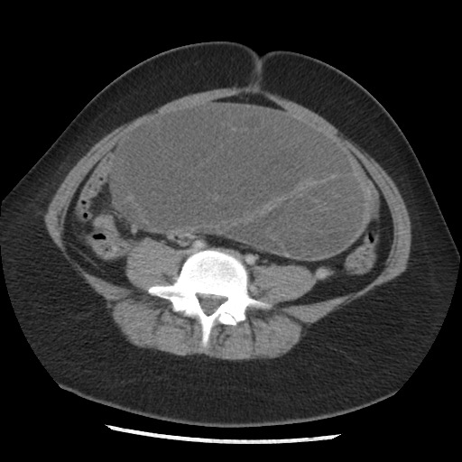 File:Borderline mucinous tumor (ovary) (Radiopaedia 78228-90808 A 105).jpg