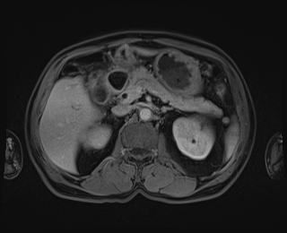 Bouveret syndrome (Radiopaedia 61017-68856 Axial T1 C+ fat sat 34).jpg