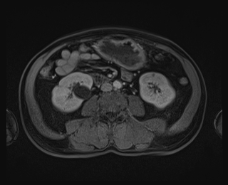 File:Bouveret syndrome (Radiopaedia 61017-68856 Axial T1 C+ fat sat 54).jpg