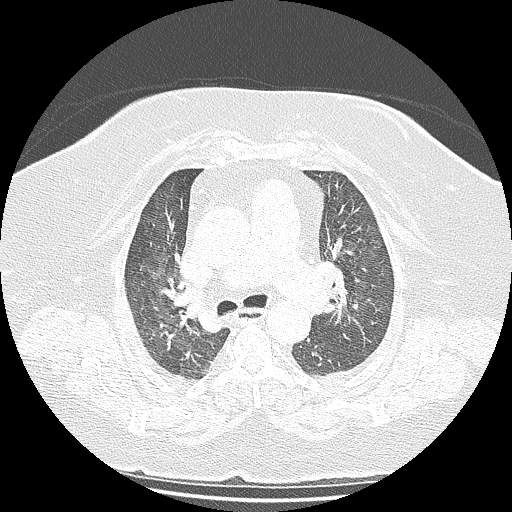 Bovine aortic arch - right internal mammary vein drains into the superior vena cava (Radiopaedia 63296-71875 Axial lung window 57).jpg