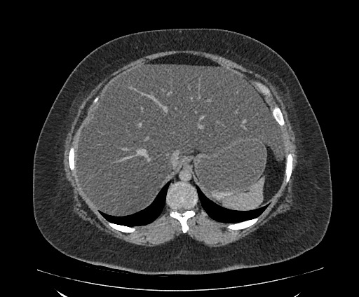 Bowel and splenic infarcts in acute lymphocytic leukemia (Radiopaedia 61055-68913 A 33).jpg