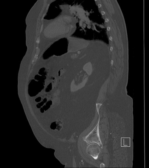 Bowel ischemia secondary to SMA occlusion with extensive portomesenteric venous gas (Radiopaedia 54656-60871 Sagittal bone window 30).jpg