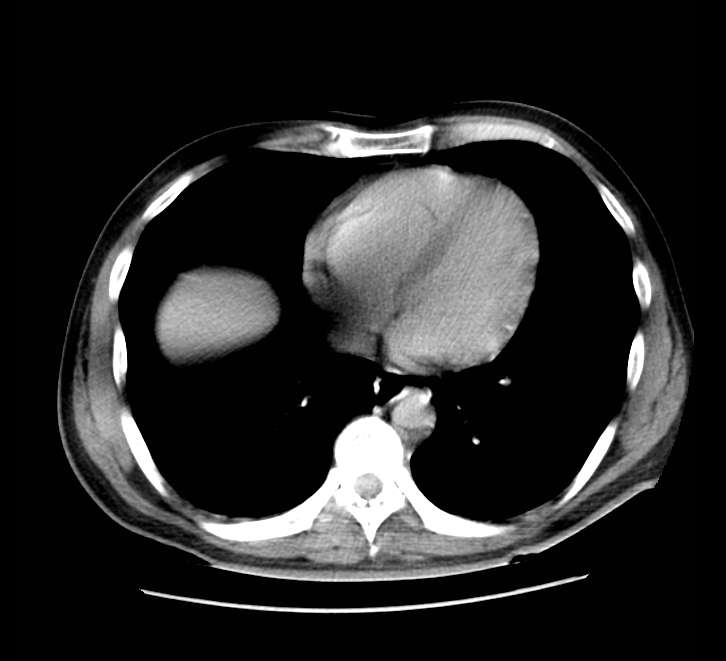 Bowel obstruction from colon carcinoma (Radiopaedia 22995-23028 A 3).jpg