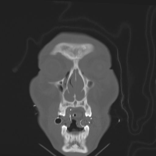 Brain contusions, internal carotid artery dissection and base of skull fracture (Radiopaedia 34089-35339 Coronal bone window 14).png