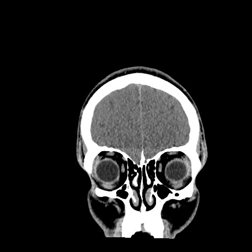 File:Brain death (Radiopaedia 78597-91360 Coronal non-contrast 15).jpg