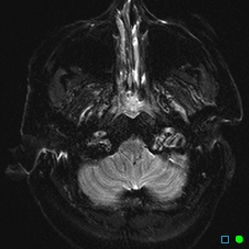 File:Brain death on MRI and CT angiography (Radiopaedia 42560-45689 Axial ADC 6).jpg