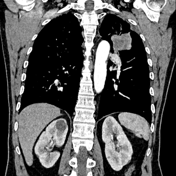 Brain metastases - lung cancer primary (Radiopaedia 75060-86116 C+ arterial phase 46).jpg