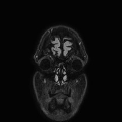 Brain metastases from lung cancer (Radiopaedia 83839-99028 Coronal FLAIR 1).jpg