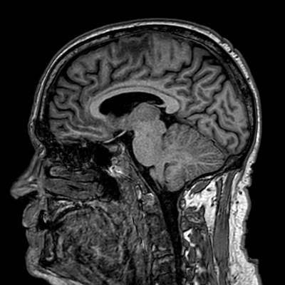 Brain metastases from lung cancer (Radiopaedia 83839-99028 Sagittal T1 70).jpg