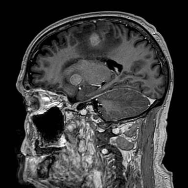 Brain metastases from lung cancer (Radiopaedia 83839-99028 Sagittal T1 C+ 41).jpg