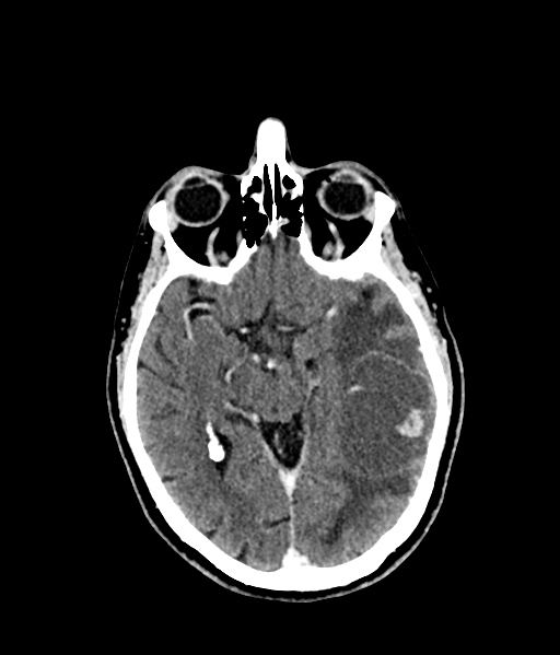 Brain metastasis (large cystic mass) (Radiopaedia 47497-52106 Axial C+ 29).png