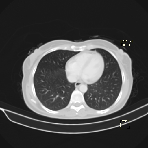 File:Brain metastasis as initial presentation of non-small cell lung cancer (Radiopaedia 65122-74127 Axial lung window 33).jpg