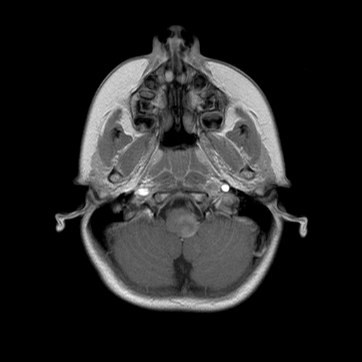 File:Brainstem ganglioglioma (Radiopaedia 10763-11224 Axial T1 C+ 13).jpg