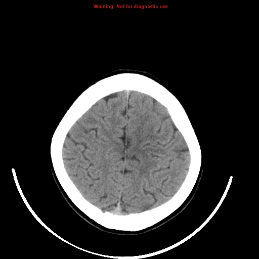File:Brainstem glioma (Radiopaedia 9444-10123 non-contrast 21).jpg