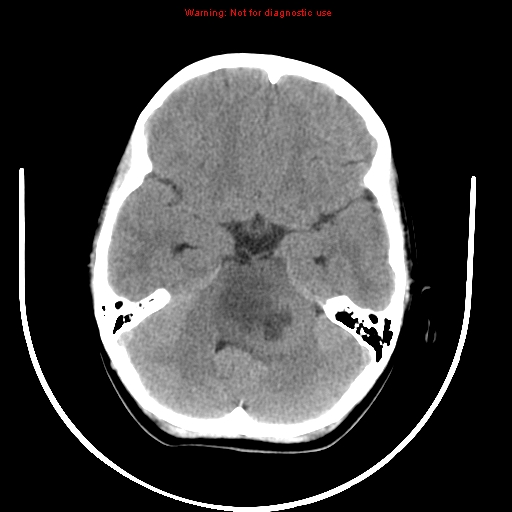 File:Brainstem glioma (Radiopaedia 9444-10123 non-contrast 6).jpg