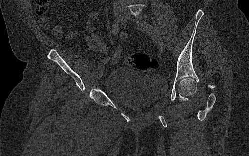 Breast carcinoma with pathological hip fracture (Radiopaedia 60314-67993 Coronal bone window 66).jpg
