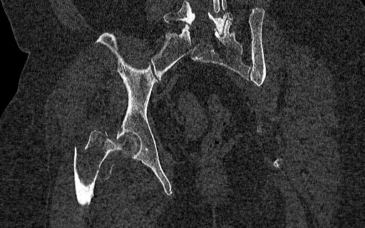 File:Breast carcinoma with pathological hip fracture (Radiopaedia 60314-67993 Coronal bone window 79).jpg