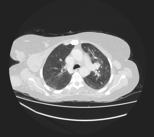 Breast metastases from facial malignant melanoma (Radiopaedia 60316-67975 Axial lung window 33).jpg