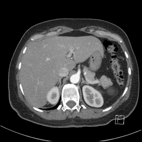 Breast metastases from renal cell cancer (Radiopaedia 79220-92225 A 87).jpg