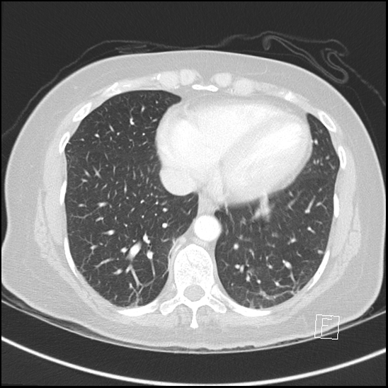 File:Breast metastases from renal cell cancer (Radiopaedia 79220-92225 Axial lung window 63).jpg