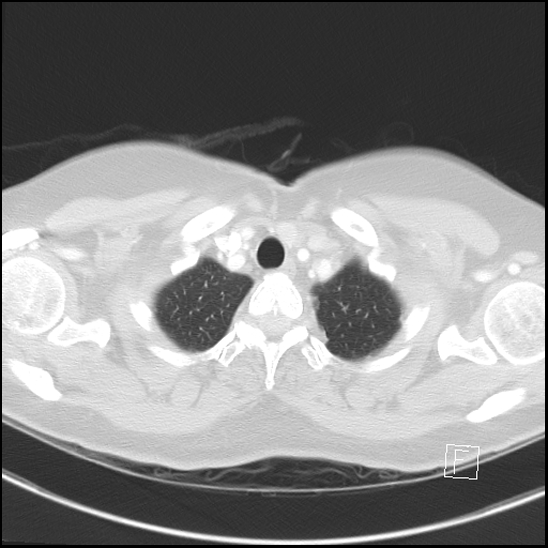 File:Breast metastases from renal cell cancer (Radiopaedia 79220-92225 Axial lung window 7).jpg