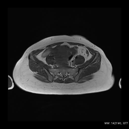 File:Broad ligament fibroid (Radiopaedia 49135-54241 Axial T1 7).jpg
