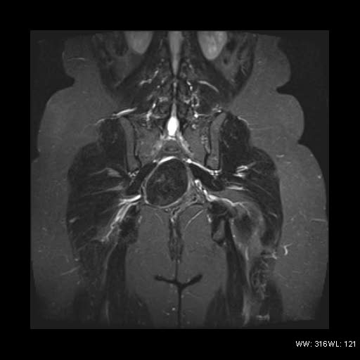 File:Broad ligament fibroid (Radiopaedia 49135-54241 Coronal STIR 20).jpg