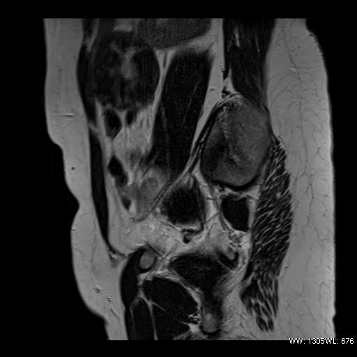 File:Broad ligament fibroid (Radiopaedia 49135-54241 Sagittal T2 22).jpg