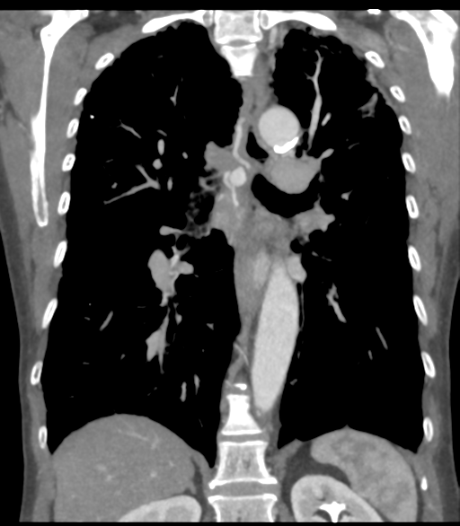 File:Bronchial artery aneurysms (Radiopaedia 42282-45385 Coronal C+ delayed 41).png