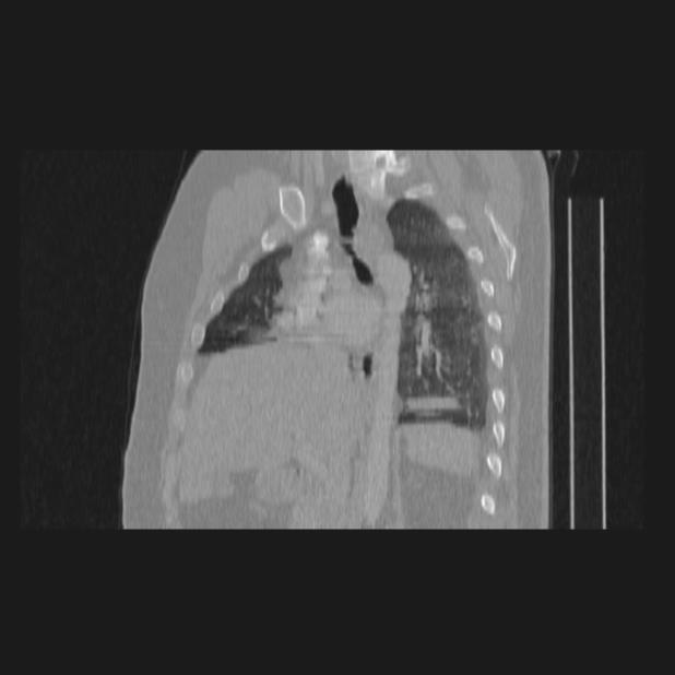 Bronchial atresia (Radiopaedia 60685-68439 Sagittal lung window 45).jpg