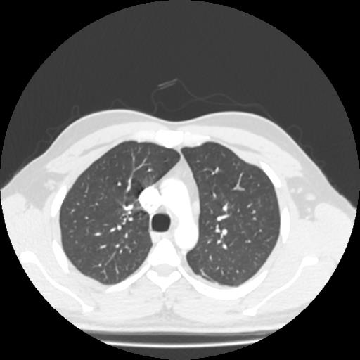 Bronchial carcinoid (Radiopaedia 80013-93291 Axial lung window 30).jpg