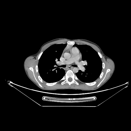 Bronchial carcinoid tumor (Radiopaedia 57187-64090 A 30).jpg