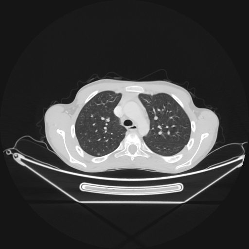 Bronchial carcinoid tumor (Radiopaedia 57187-64090 Axial lung window 20).jpg
