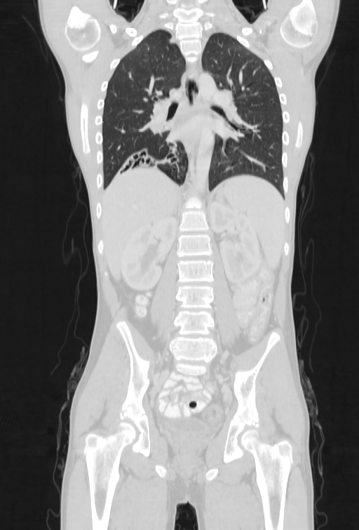 Bronchial carcinoid tumor (Radiopaedia 57187-64090 Coronal lung window 63).jpg