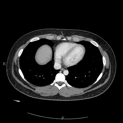 File:Bronchial carcinoid tumor (Radiopaedia 78272-90875 A 70).jpg