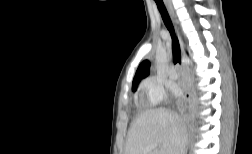 Bronchial mucoepidermoid carcinoma (Radiopaedia 57023-63895 Sagittal 98).jpg