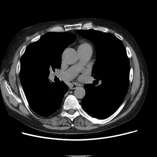 Bronchial stenosis - lung transplant (Radiopaedia 73133-83848 Axial non-contrast 33).jpg