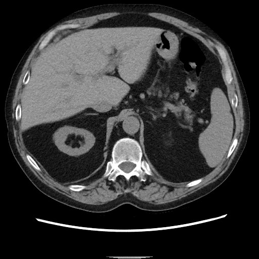 Bronchial stenosis - lung transplant (Radiopaedia 73133-83848 Axial non-contrast 59).jpg