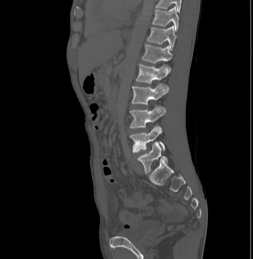 File:Bronchiectasis in Crohn disease (Radiopaedia 60311-67977 Sagittal bone window 145).jpg