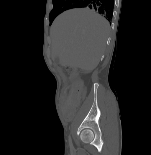 File:Bronchiectasis in Crohn disease (Radiopaedia 60311-67977 Sagittal bone window 29).jpg