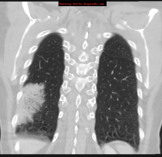 Bronchoalveolar carcinoma (BAC) (Radiopaedia 13436-13392 Coronal lung window 50).jpg