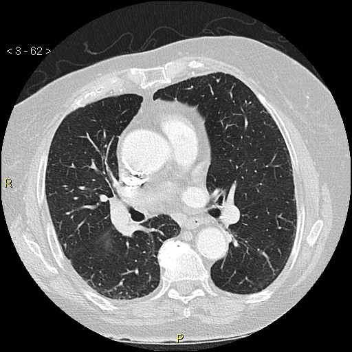 Bronchogenic carcinoma as an incidental finding (Radiopaedia 16453-16130 Axial lung window 62).jpg