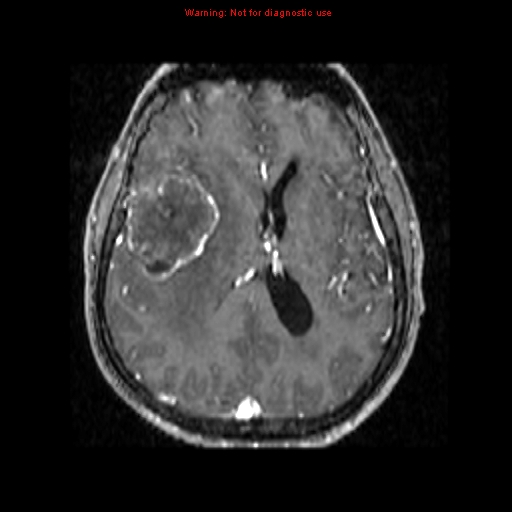 File:Bronchogenic carcinoma brain metastasis (Radiopaedia 9286-9969 Axial T1 C+ 8).jpg