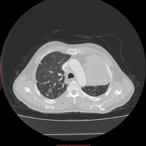 File:Bronchogenic carcinoma with left atrial large deposit - T4N3M1a (Radiopaedia 42316-45428 Axial lung window 10).jpg