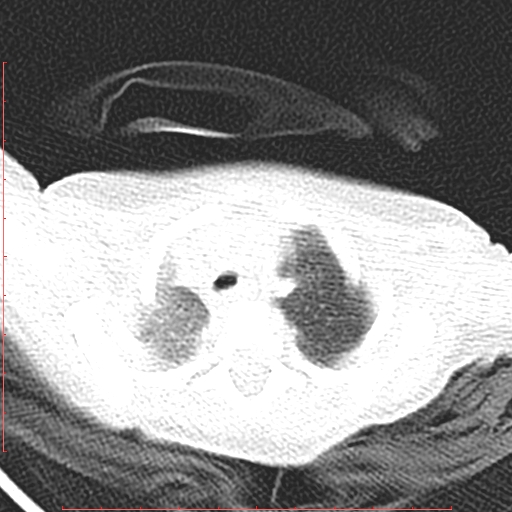 Bronchogenic cyst (Radiopaedia 78599-91409 Axial lung window 30).jpg
